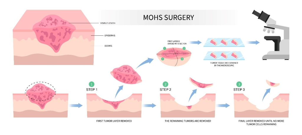 Mole Skin Cancer Removal Dermatology Collective mole-skin-cancer-removal-dermatology-collective