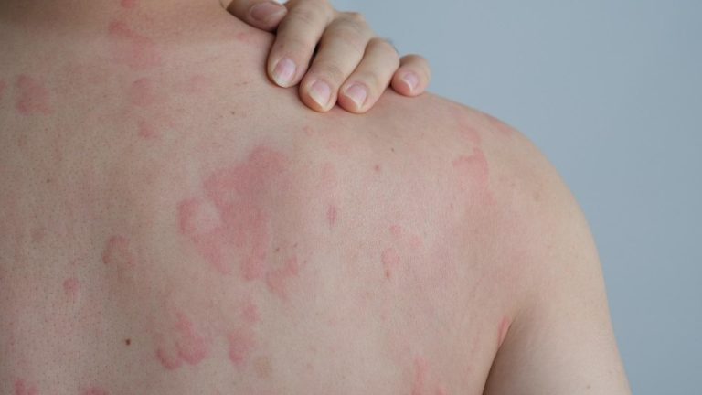 urticaria treatment Singapore.