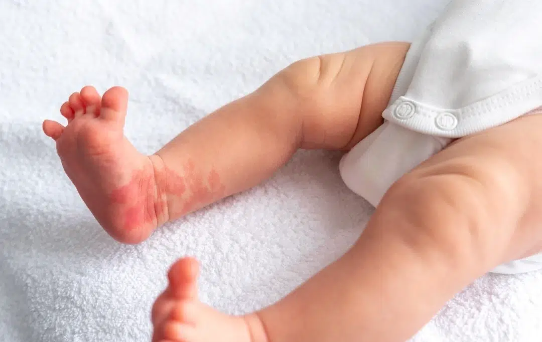 birthmarks in babies Singapore.