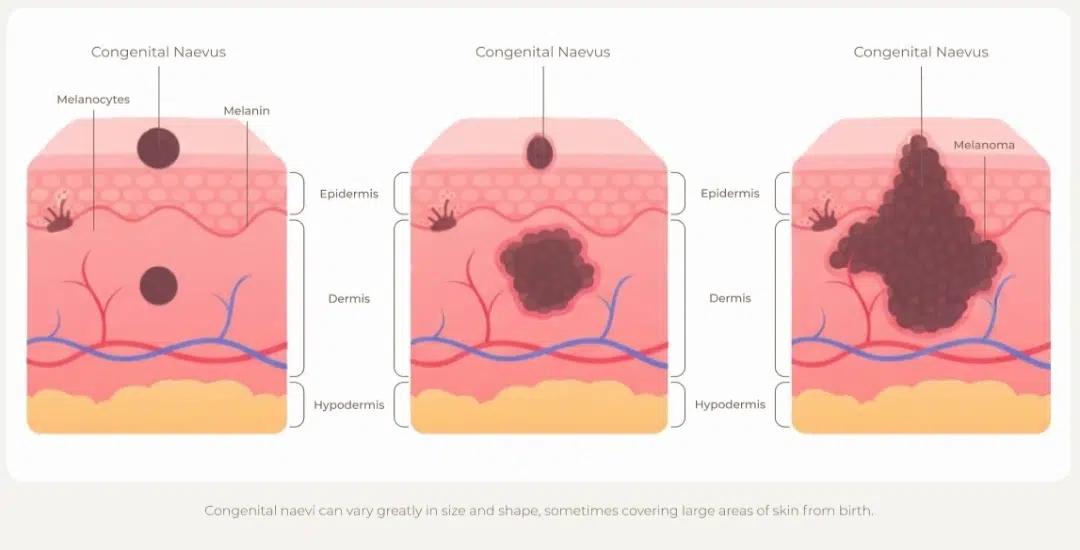 congenital naevus with potential malignant transformation.