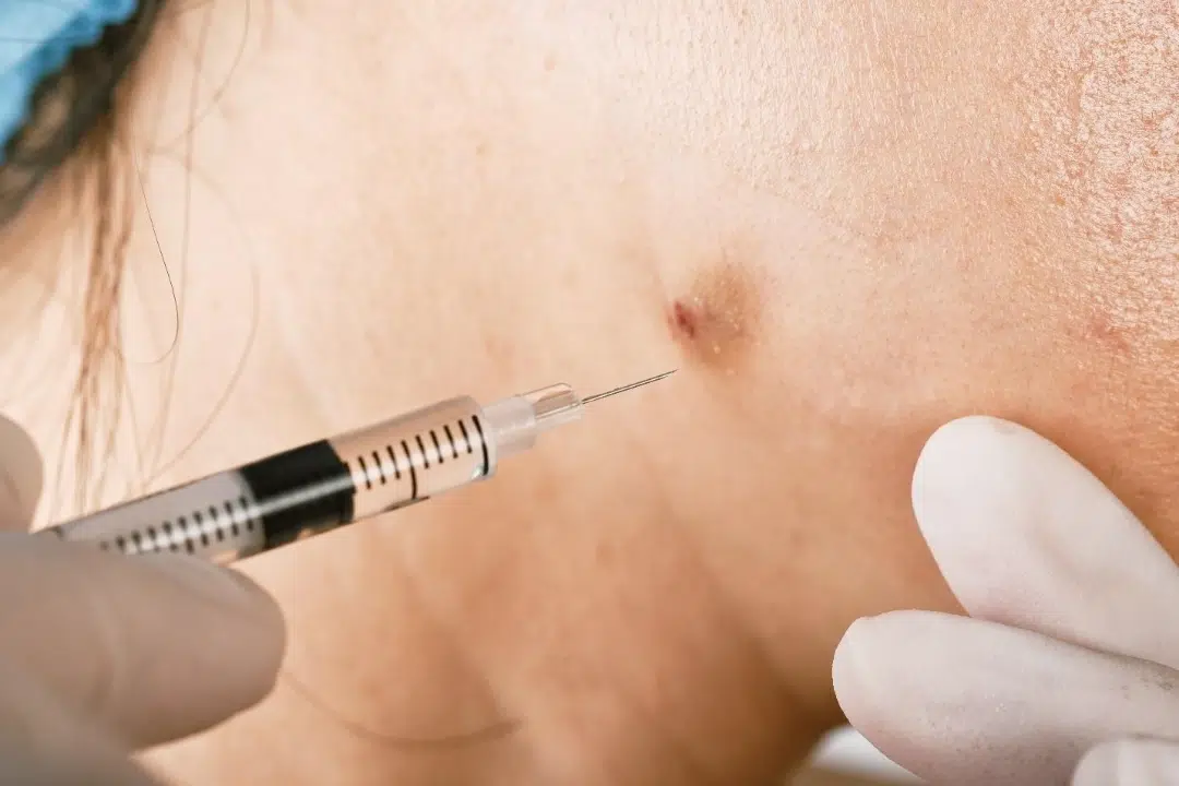 intralesional steroid injection for cystic acne and inflamed skin lesions.