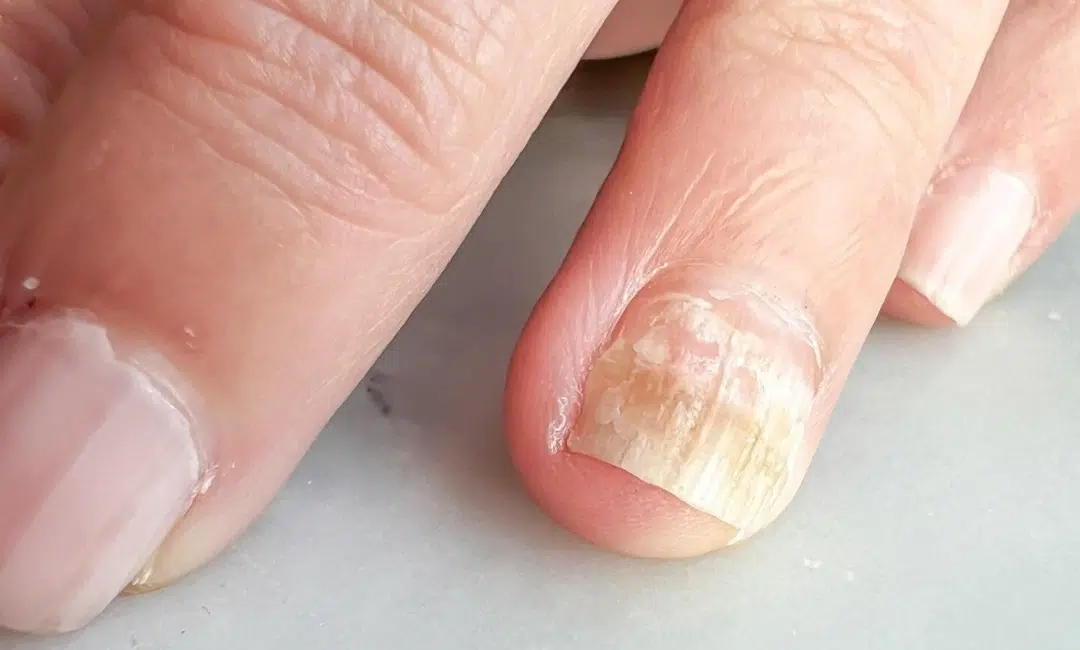 nail fungal Singapore.