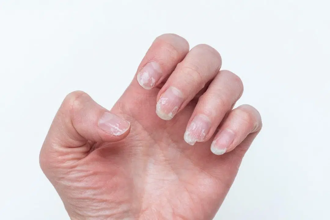 what causes brittle nails.