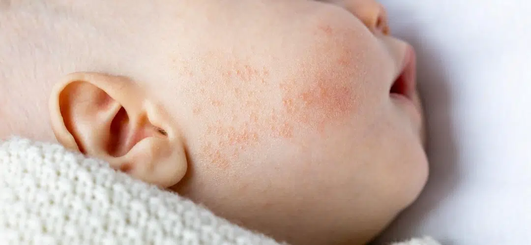 newborn rashes in Singapore.