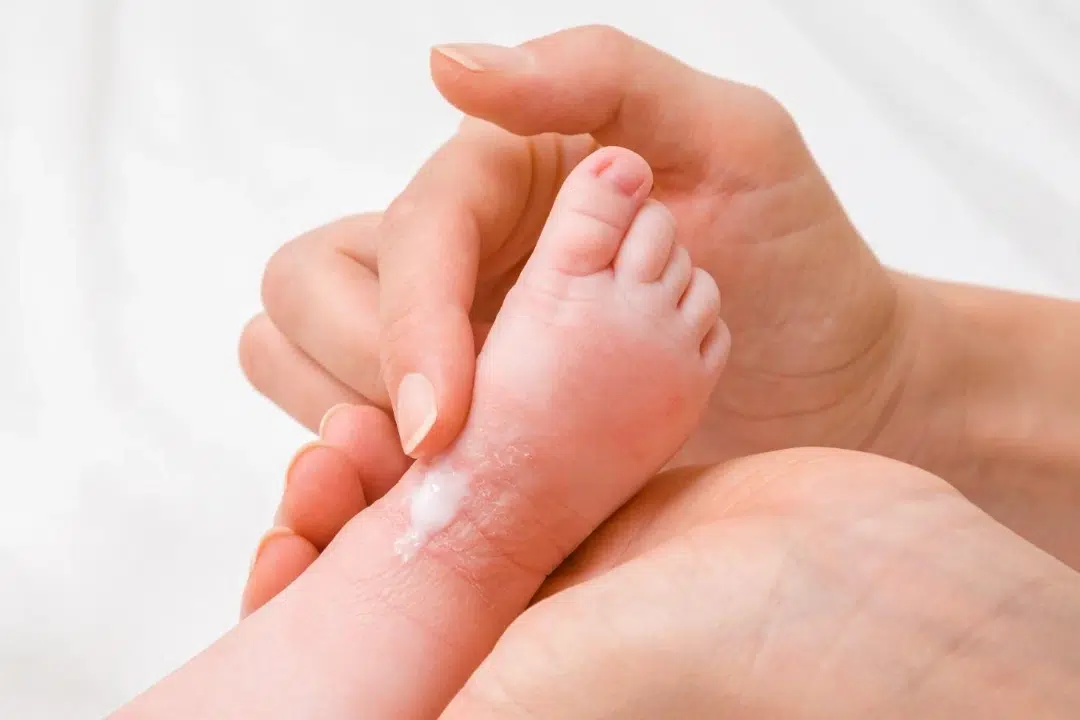 treatment for newborn rashes.