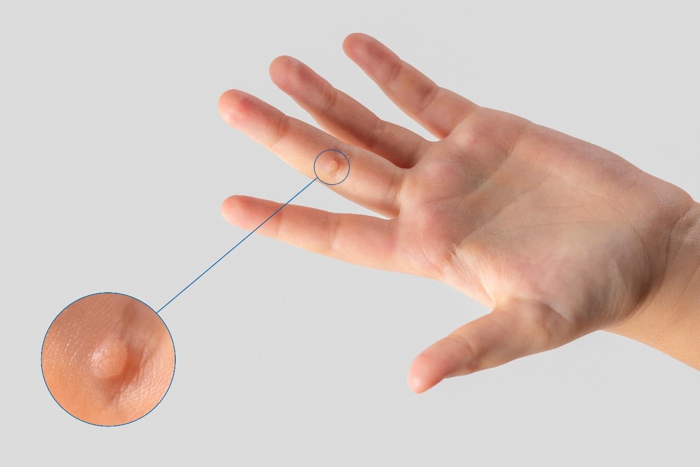 cryotherapy compared to other skin lesion treatments.