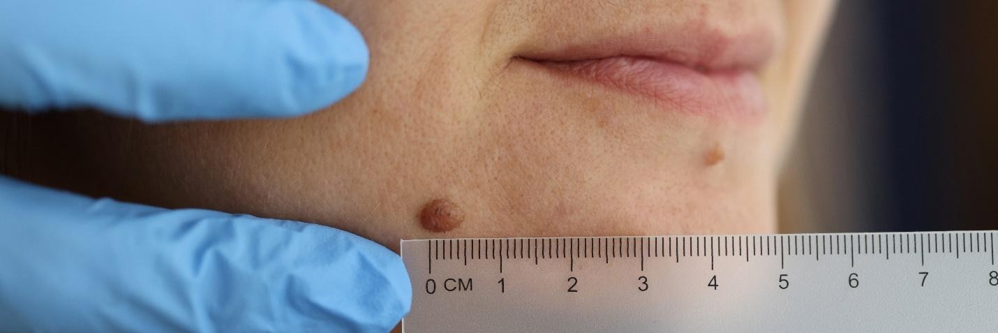 skin evaluation before cryotherapy for safe treatment.