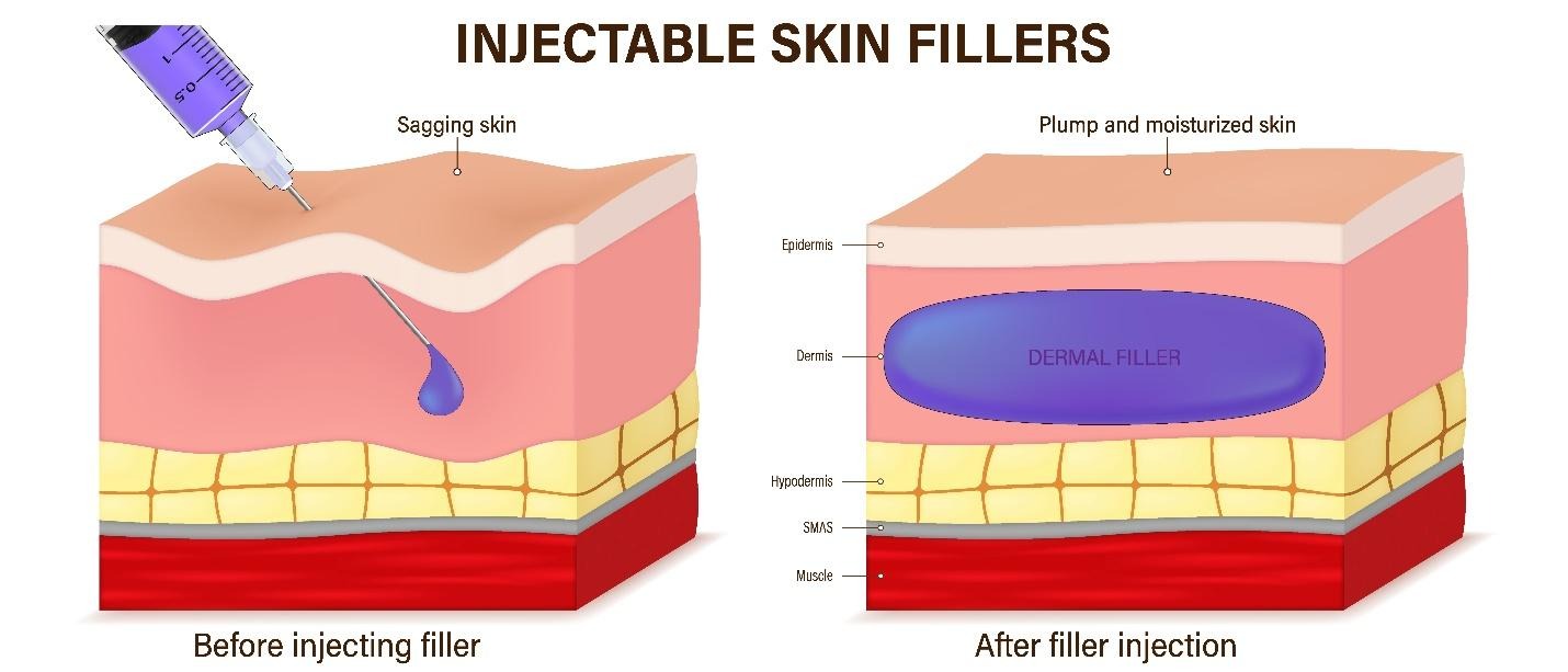 improved facial volume and contour after dermal filler treatments.