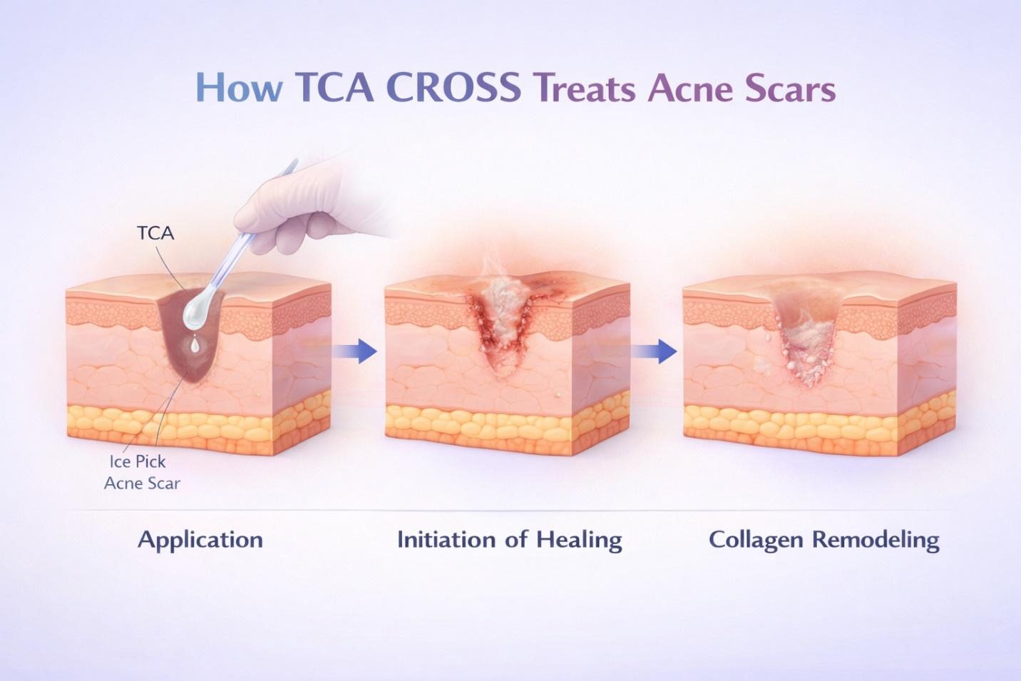 applying TCA CROSS to deep acne scars to promote natural collagen production.