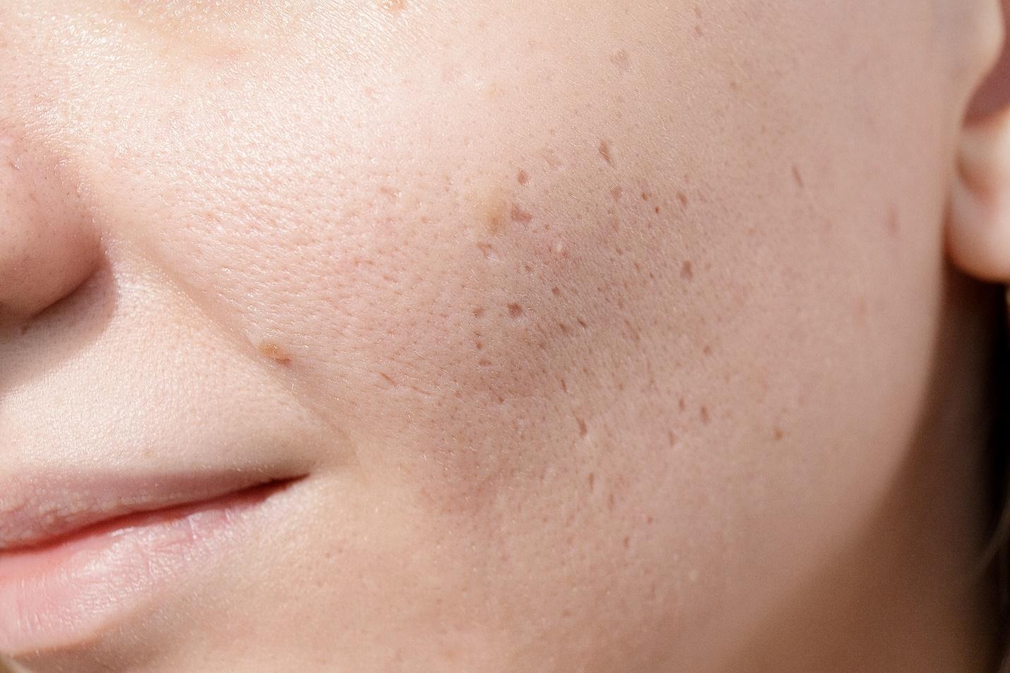 how to treat acne scars in Singapore.