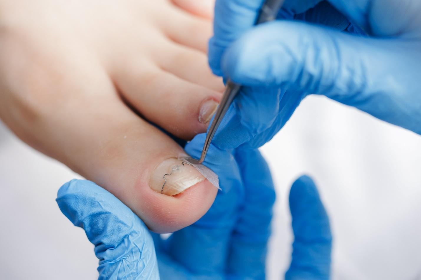 nail surgery for ingrown nails and recurrent nail problems.