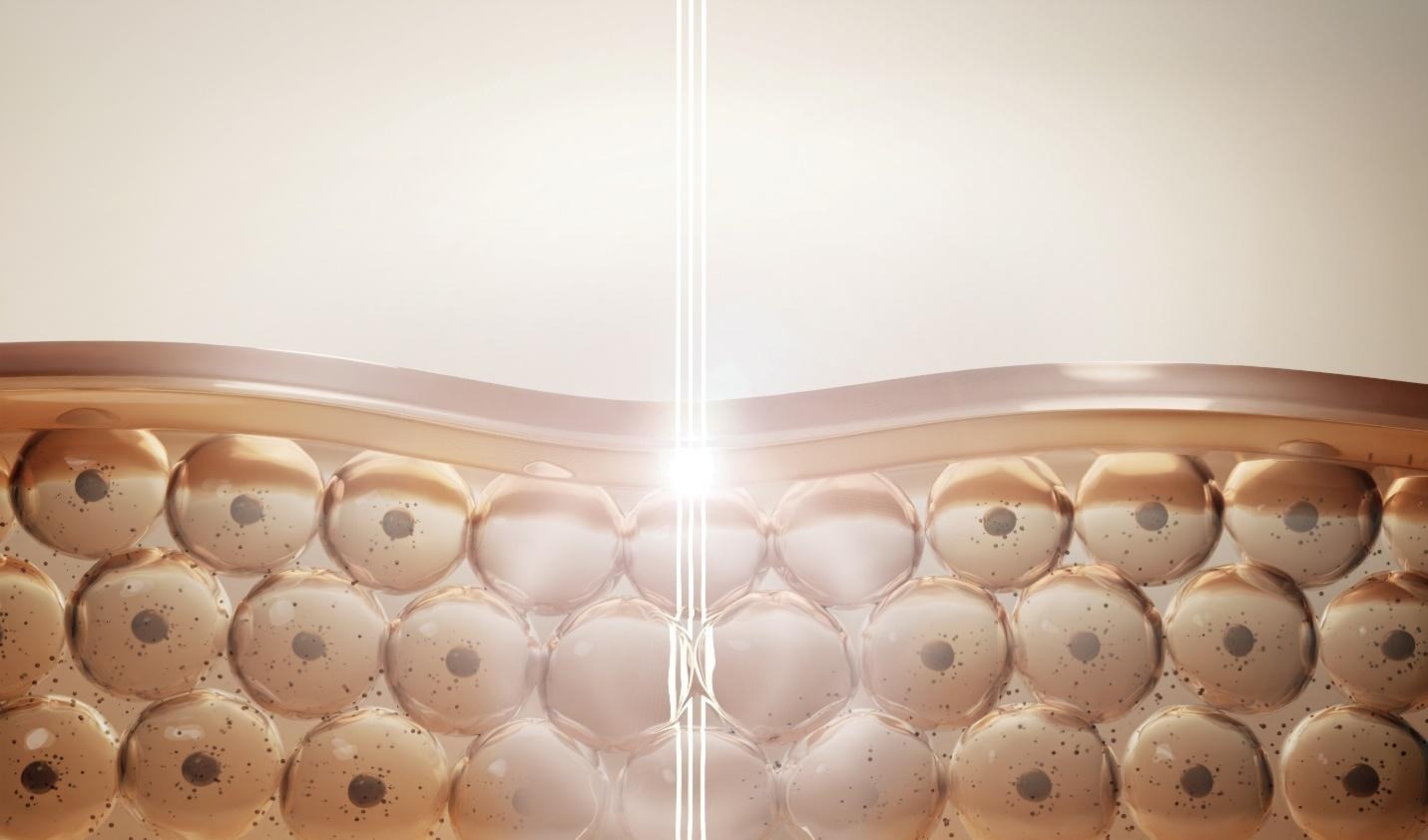 rejuvenation lasers target deeper skin layers to support natural collagen remodelling.