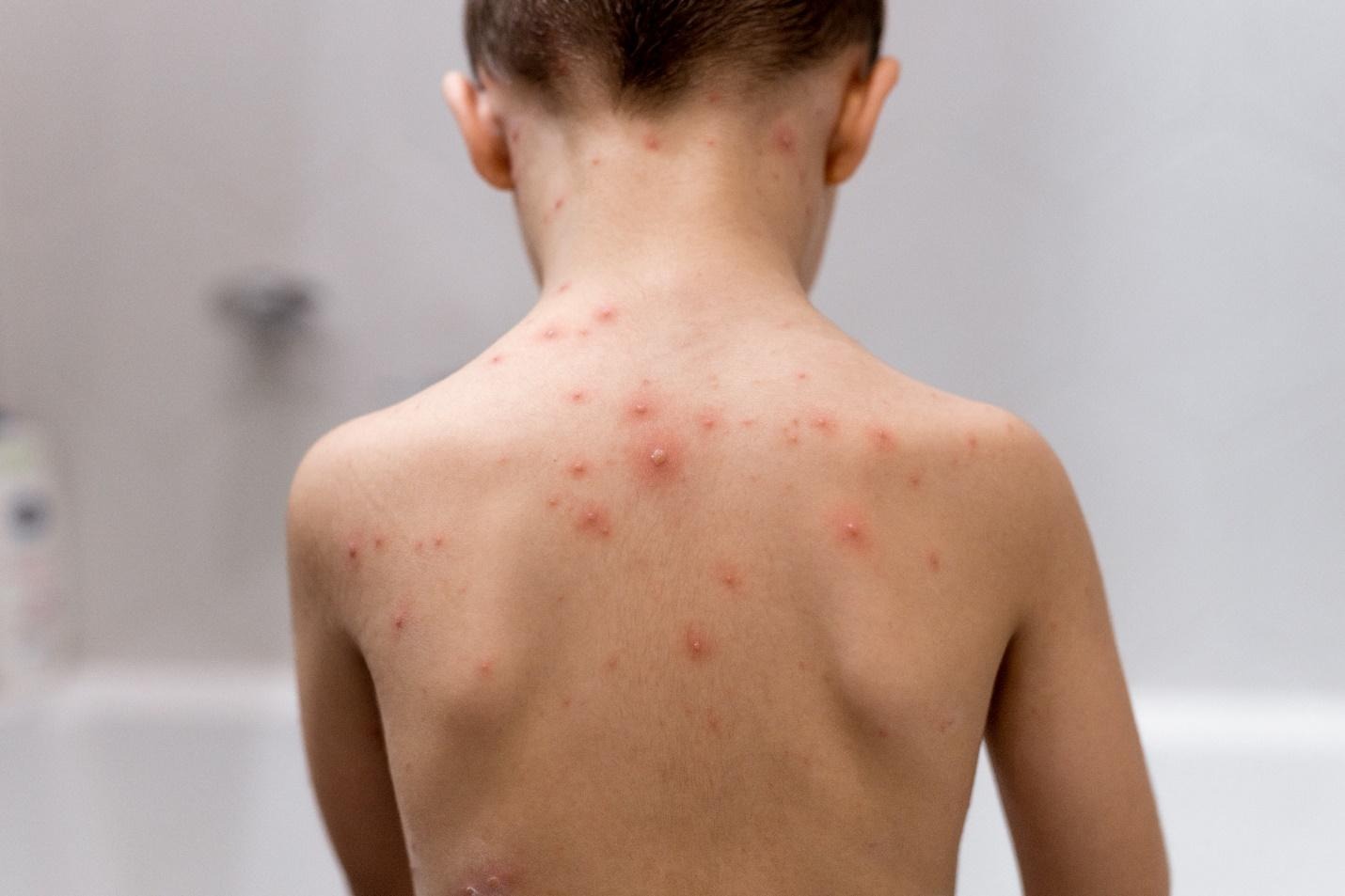 common skin infections in children.