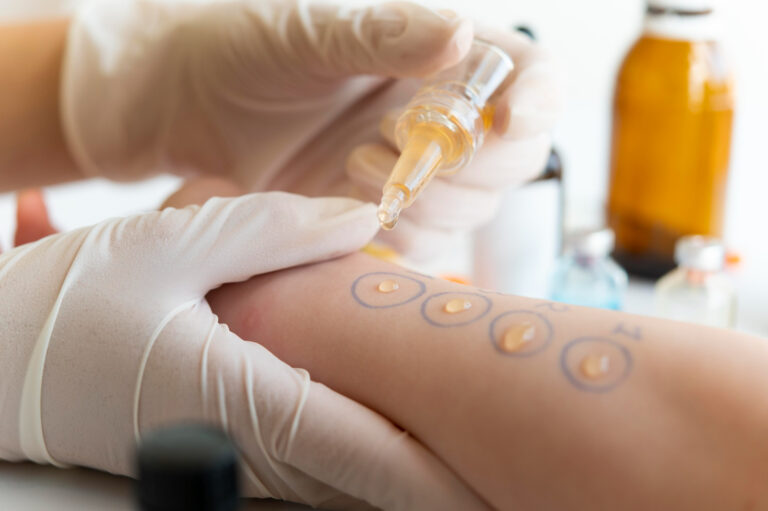 Allergy Testing