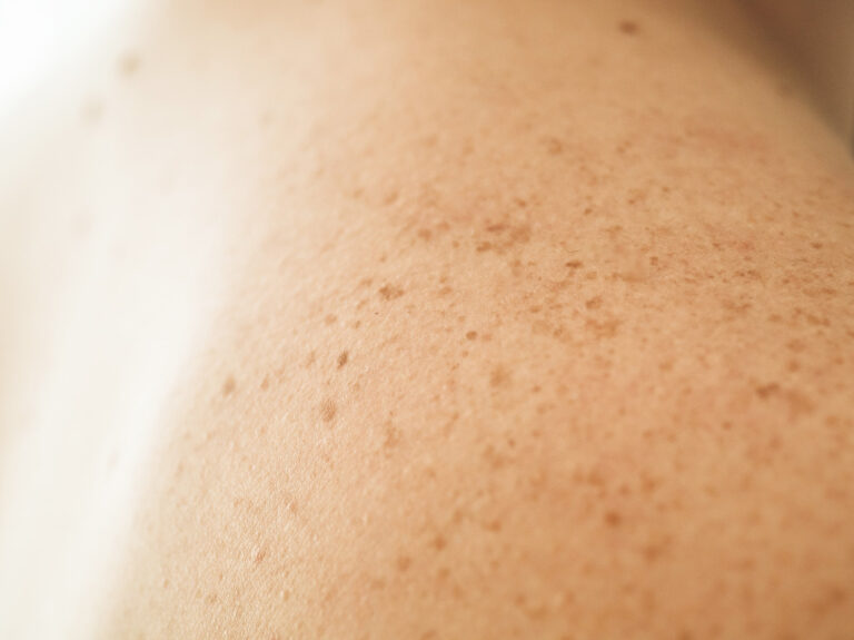 Close-up of light brown skin covered with numerous small freckles and pores.